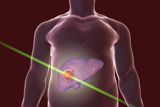 Liver cancer treatment with laser. Conceptual image. 3D illustration
