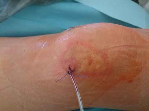 Drainage im Knie nach Arthroskopie