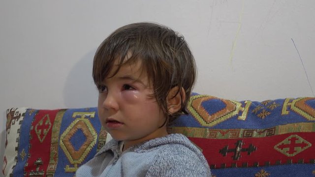 4K Child with bump under his eye caused by intolerance to insect stings