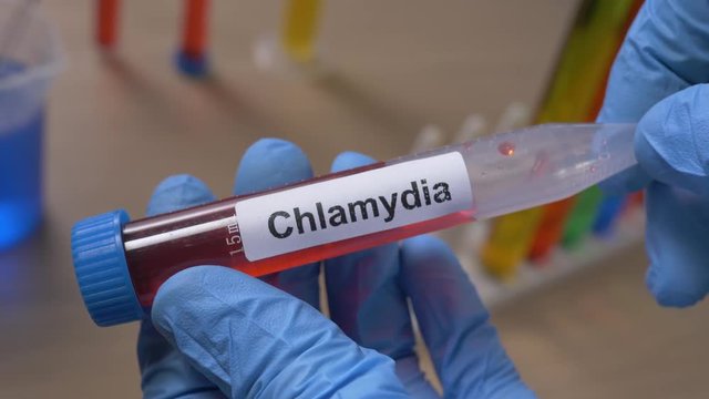 Scientist holding a Chlamydia test tube filled with a red substance. Filmed in a lab environment. Closeup on the tube.