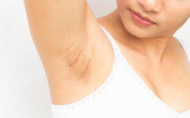 Women problem black armpit on white background for skin care and beauty concept