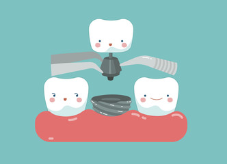 Tooth implant ,teeth and tooth concept of dental
