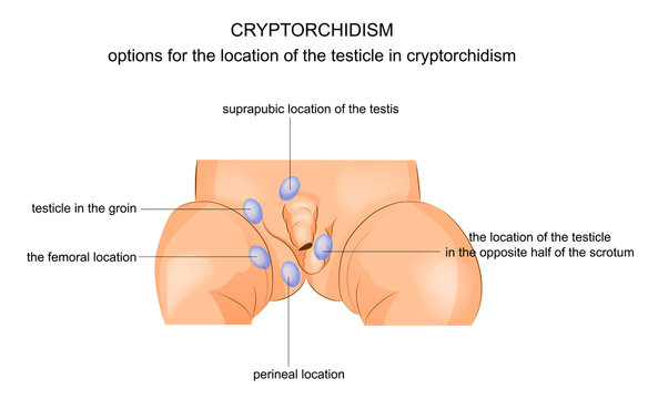  cryptorchidism. options for the location of the testicle