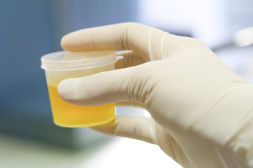 Healthcare And Medicine. Medical urine test, close-up