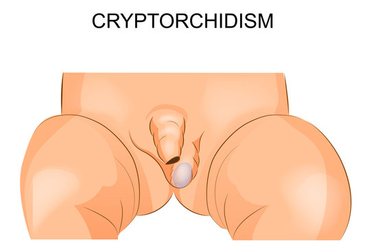cryptorchidism. the absence of the testicle in the scrotum