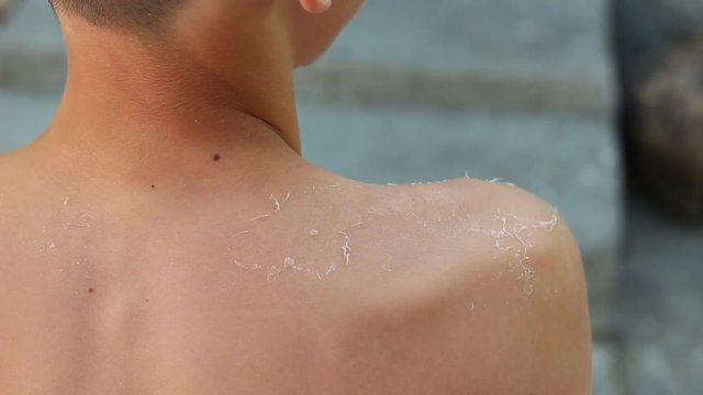 Peeling skin from a sunburn