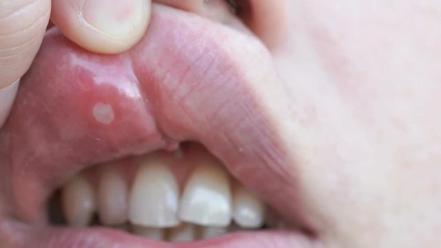 Close-up of stomatitis into mouth. Man bends his upper lip and shows stomatitis