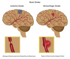 Types of brain stroke