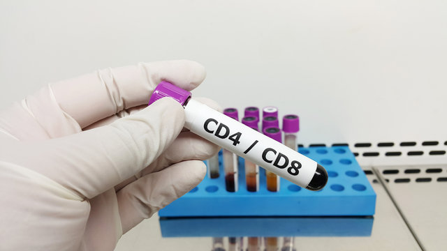 Hand holding blood sample for CD4 /CD8 testing for monitor HIV infected.