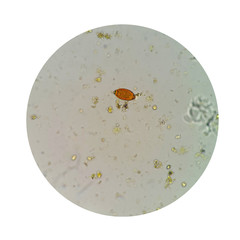 Stool parasites examination test for parasites or eggs in a human stool sample with iodine stained...