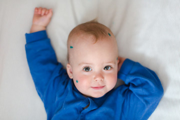 Baby with chickenpox on bed