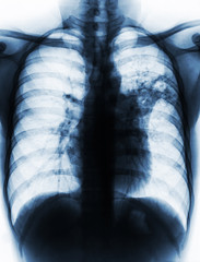 Pulmonary Tuberculosis . Film chest x-ray show alveolar infiltrate at left middle lung due to...