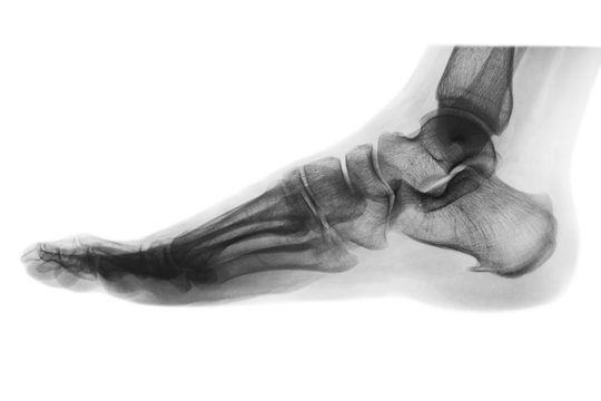 X-ray normal human foot . Lateral view . Invert color style .