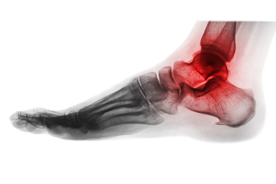 Arthritis of ankle . X-ray of foot . Lateral view . Invert color style .
