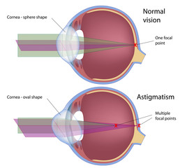 Astigmatism, a common eye defect