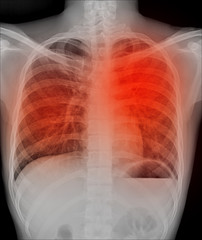 View of a human x-ray film, taken to examine the lungs
