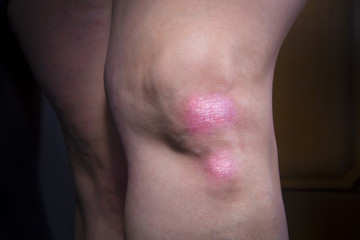 Psoriasis on ladys knee