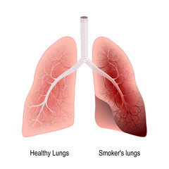 Smoker's lung and healthy lung
