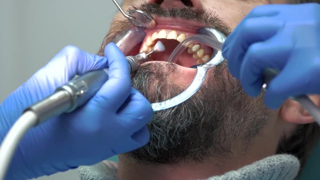 Dentist brushing teeth close up. Dental cheek retractor. Tooth enamel restoration.