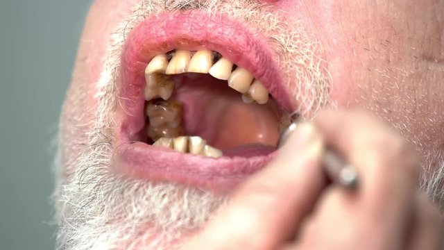 Close up of bad teeth. Examination of patient by dentist. Tobacco use influences dental health.