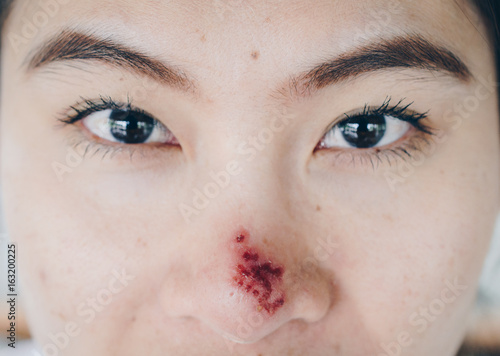 The Herpes Simplex On Asian Woman Nose Herpes Simplex Is A Viral