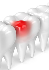 3d render of teeth with toothache over white