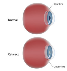 Eye disease - cataract - clouding of the lens