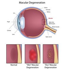 Eye condition: macular degeneration