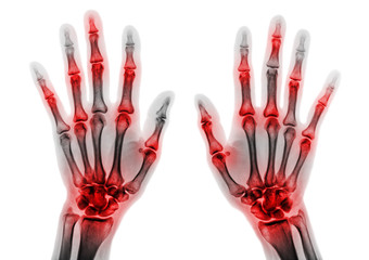 Arthritis multiple joint of fingers . Film x-ray of both hands and wrists .