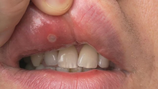 Stomatitis into mouth. Man bends his upper lip and shows sore spot of ulcer. Close-up