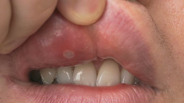 Stomatitis into mouth. Man bends his upper lip and shows sore spot of ulcer. Close-up