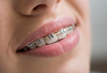 Macro shot of white teeth with braces. Smiling female patient with metal brackets at the dental office