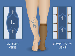 Medical compression socks for the treatment of varicose veins.