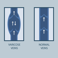 Vector illustration of a varicose vein and normal vein. Flat style.