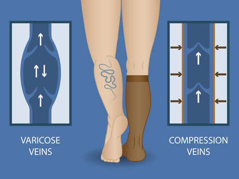 Medical compression socks for the treatment of varicose veins.