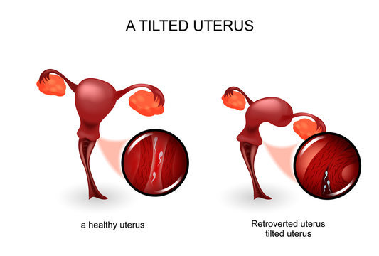 a tilted uterus. gynecology