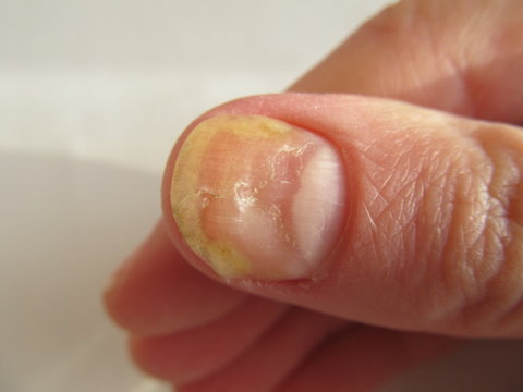 Close up of nail fungus infection