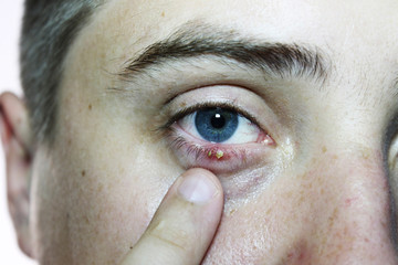 Close-up of an eye of a man. Ophthalmologic disease hordeolum eye. Doctor ophthalmologist examines...