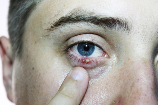 Close-up of an eye of a man. Ophthalmologic disease hordeolum eye. Doctor ophthalmologist examines purulent inflammation of the eyelid. Eyes and eyelid close-up