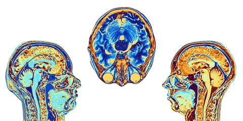 MRI scans of normal brains, artwork