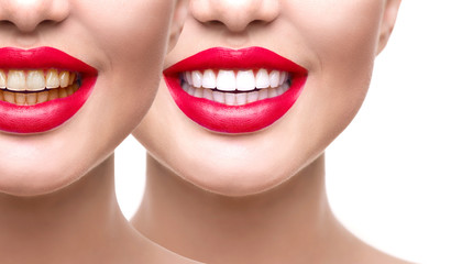 Obraz premium Woman teeth after whitening. Dental health concept