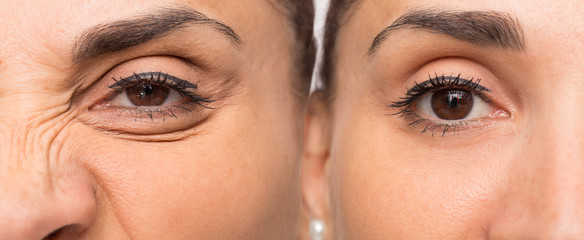 Eye of woman with and without wrinkles before and after cosmetic treatment - obrazy, fototapety, plakaty