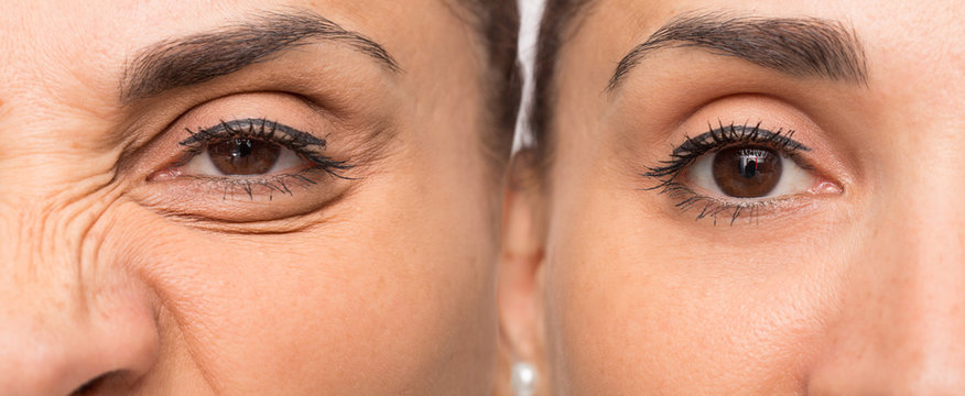 Eye of woman with and without wrinkles before and after cosmetic treatment