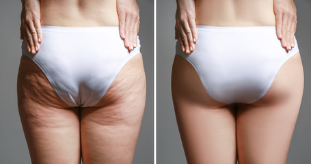 Young woman body before and after anti cellulite treatment on dark background - obrazy, fototapety, plakaty