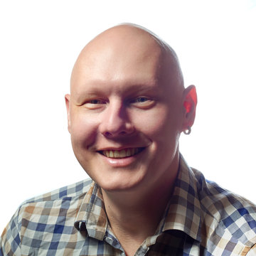 Autoimmune Total Alopecia Men Portrait. Absolute Bald Head Without Eyebrows