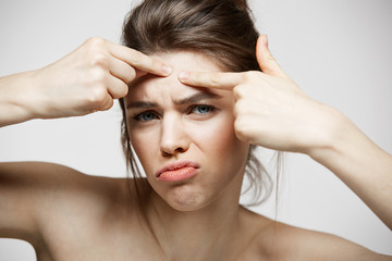 Fototapeta premium Young brunette girl displeased of her problem acne face skin over white background. Health cosmetology and skincare.