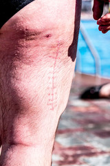 Scar from hip surgery