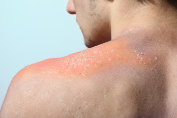 Naklejka premium Skin peeling after sunburn