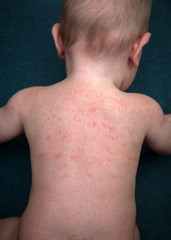 Naklejka premium Allergies, pimples on the baby's skin. Food allergy.