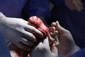 Surgeons suture the hand stump after the amputation with drainage and surgical thread close-up